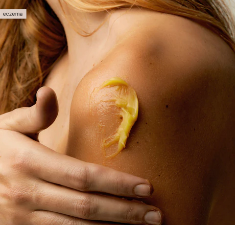 keratosis pilaris